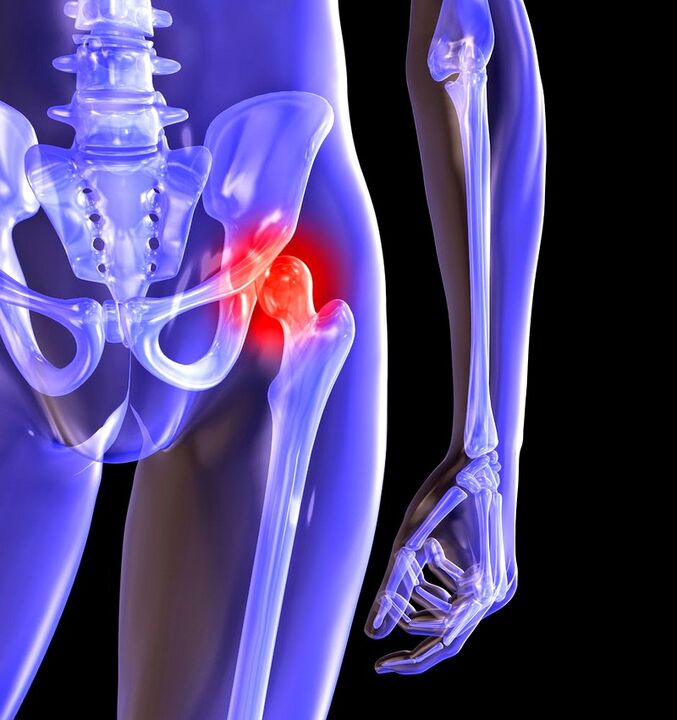 Deforming the osteoarthritis of the hip joint