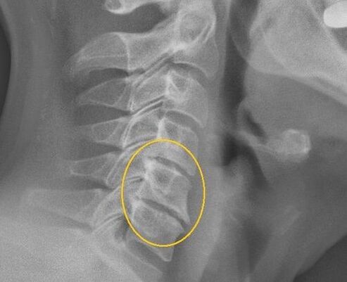 Osteochondrosis of the cervical column in an x ​​line