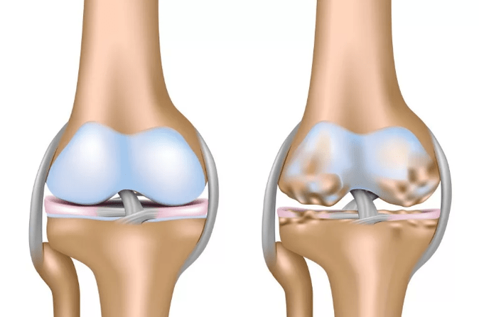 Deforming the osteoarthritis of the knee joint