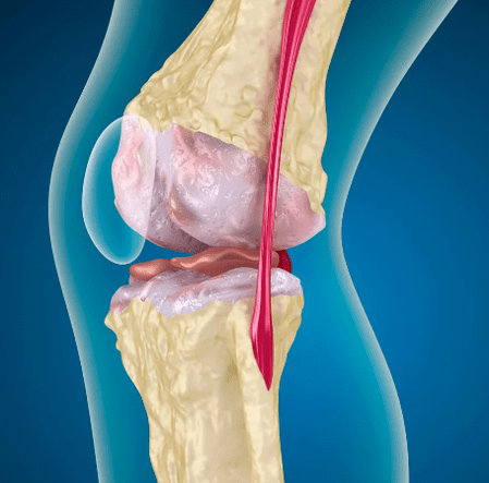 Knee joint arthrosis