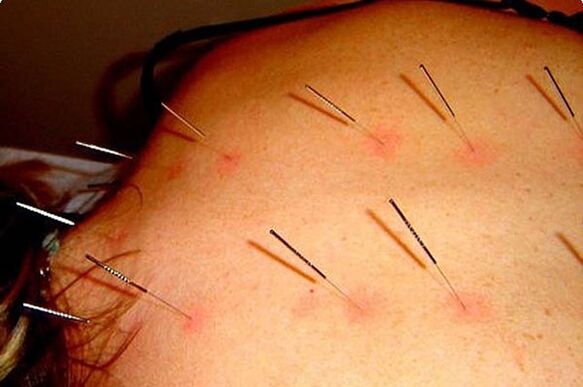 Acupuncture a method to treat cervical osteochondrosis