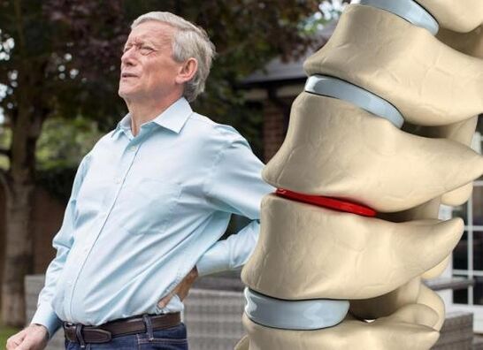 Osteochondrosis affects the intervertebral discs and causes back pain.