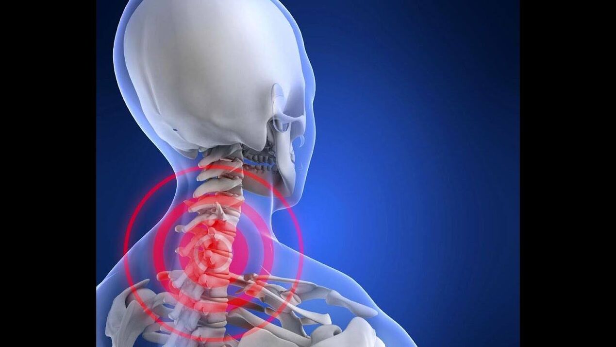 Osteochondrosis of the cervical spine.