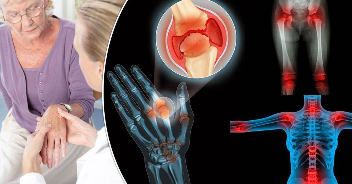 What is osteoarthritis